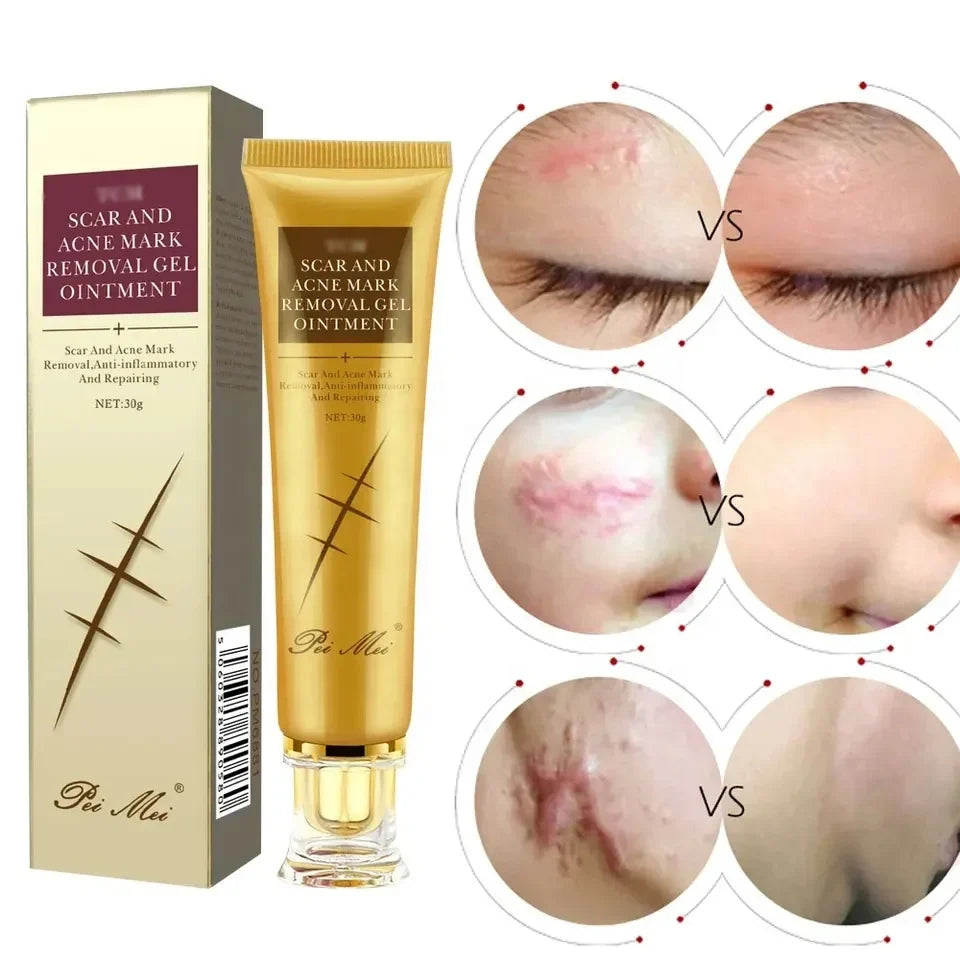 Crème Anti-Acné Rapide