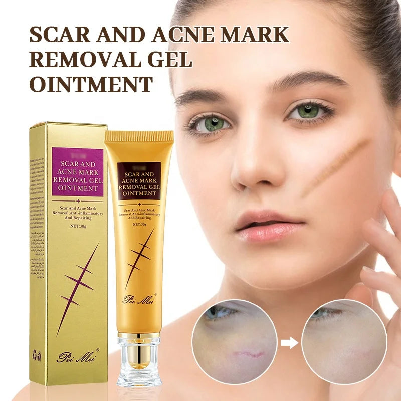 Crème Anti-Acné Rapide